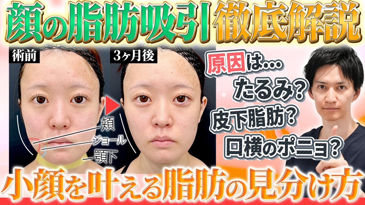 【小顔脂肪吸引】フェイスラインをすっきりと引き締める！たるみか皮下脂肪か原因の見分け方やダウンタイムや傷痕について脂肪吸引のプロが徹底的に解説します。