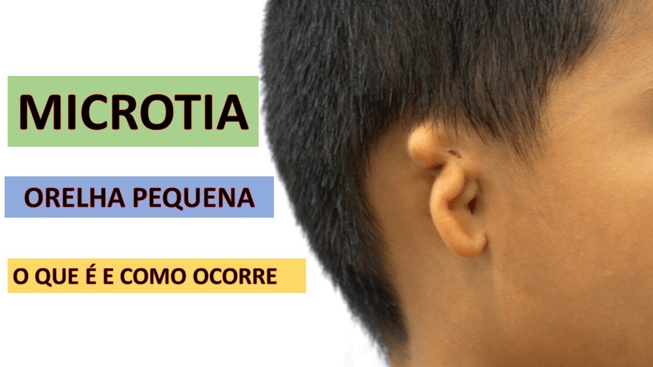 MICROTIA | ORELHA PEQUENA.