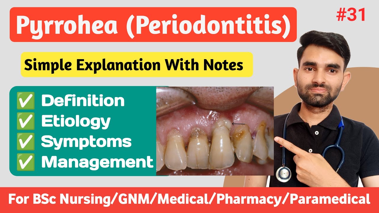 Pyorrhea Kya Hota Hai | Periodontitis in Hindi | Causes, Symptoms And Management of Pyorrhea
