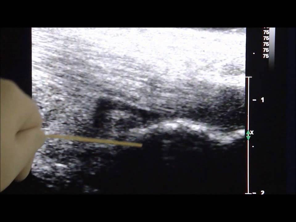 Ultrasound Guided Retrocalcaneal Bursitis Injection