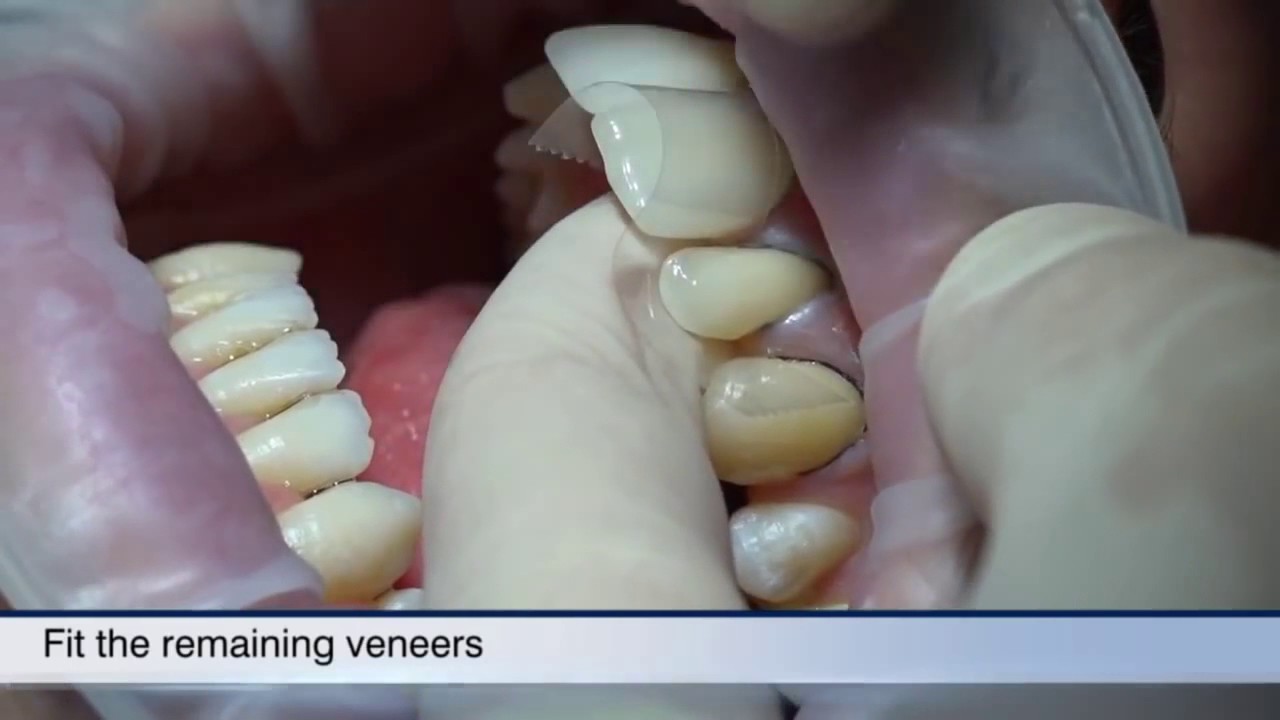 Visalys Veneer Chairside. Laminaatit suoralla tekniikalla