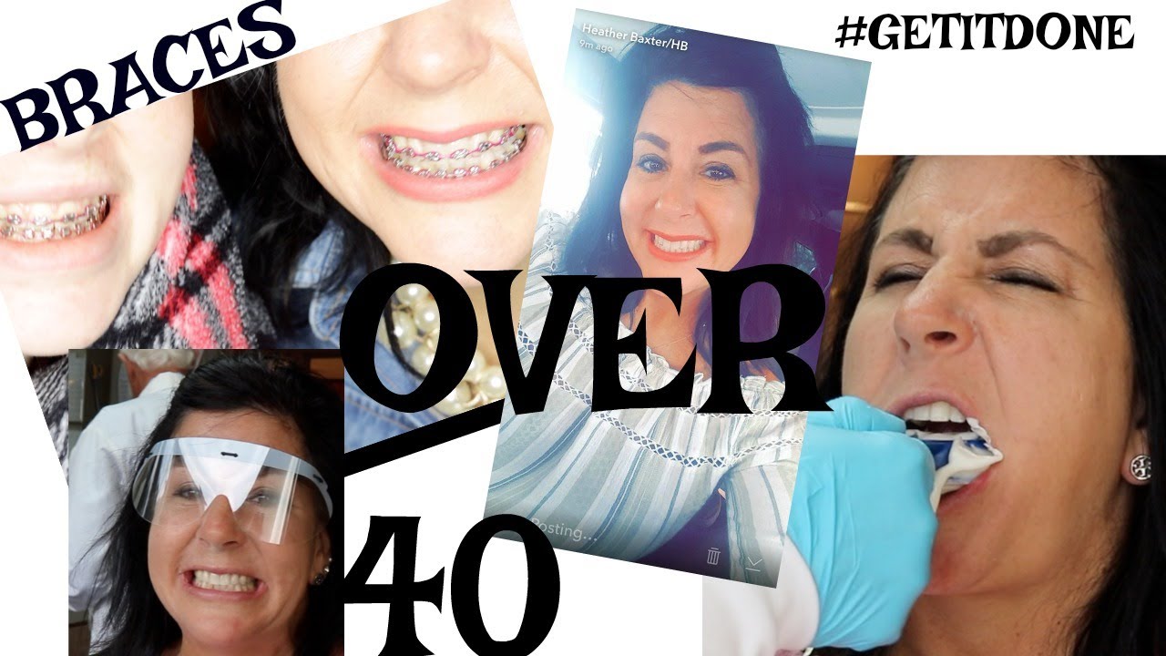 WATCH ME GET MY BRACES OFF & ADULT BRACES AFTER 40!