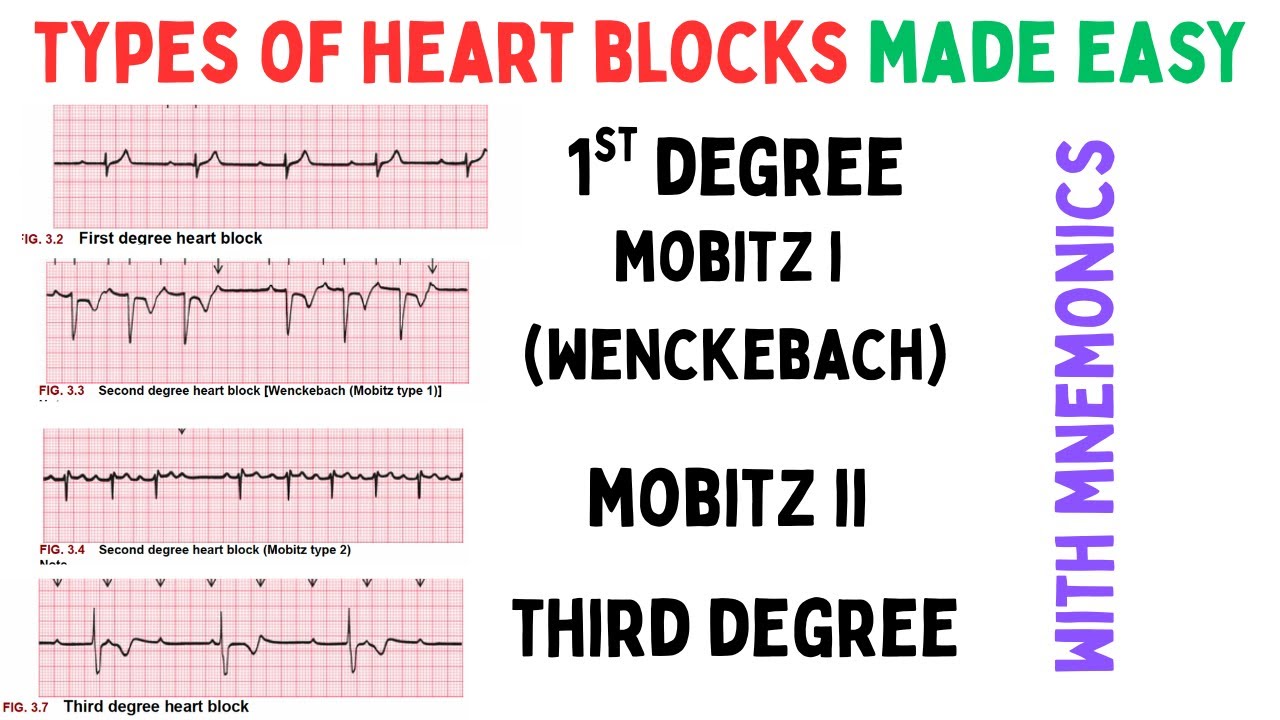 Heart Blocks Made Easy - First Degree, Mobitz I, Mobitz II, Third Degree With ECG Findings