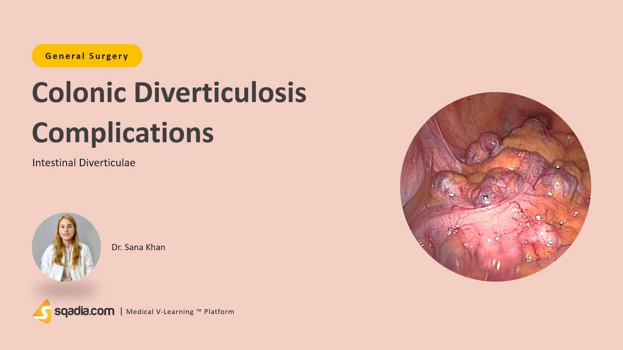 Intestinal Diverticulae | Colonic Diverticulosis Complications