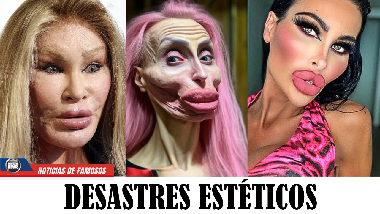 10 Celebridades Que Arruinaron Su Rostro Con Cirugías Extremas