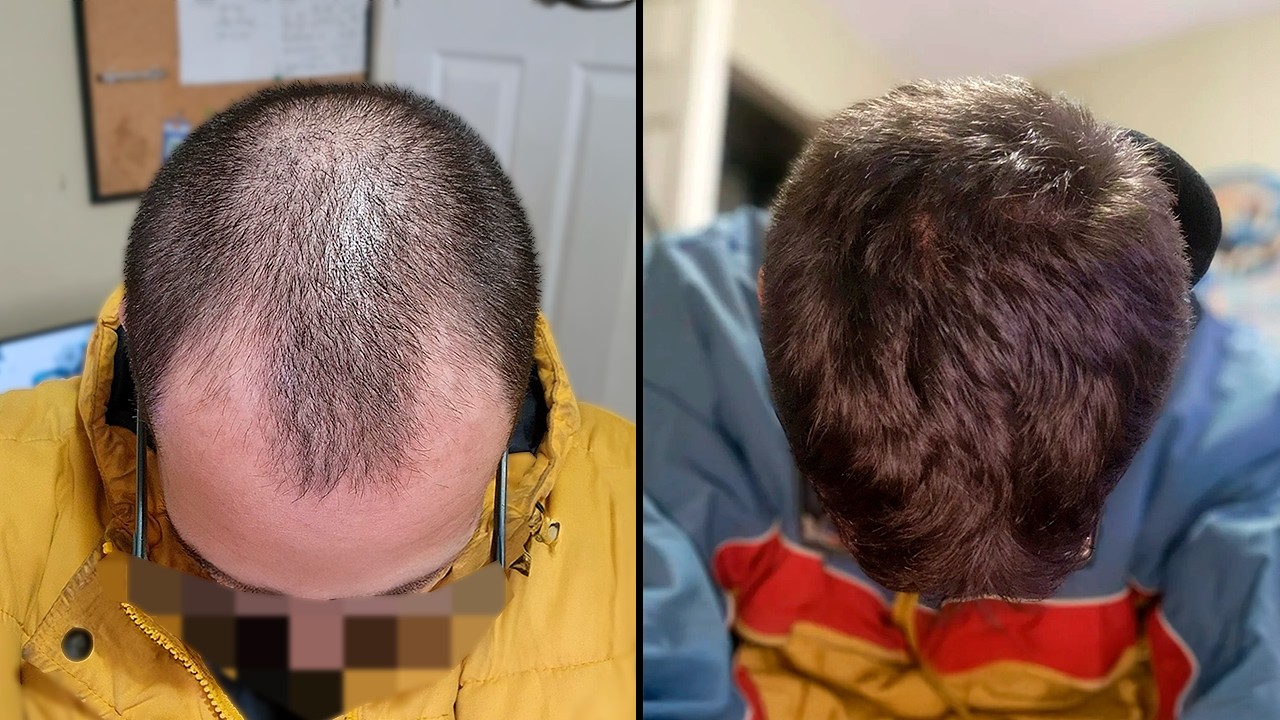 ¿Cómo Recuperé El Pelo En Solo 4 Meses Sin Pastillas?
