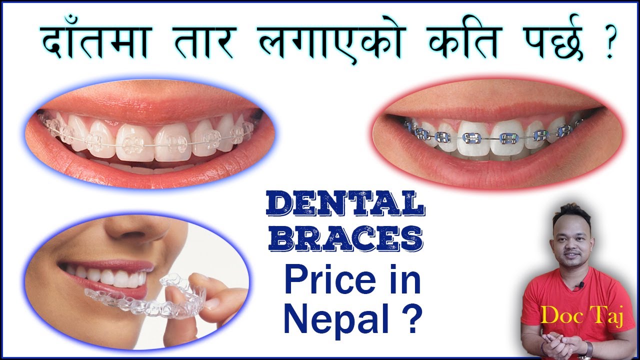 Dental braces Price in Nepal/ दाँतमा तार लगाएको कति पर्छ?/Drmaheshwar/ Doc Taj/ Orthodontics/Dentist