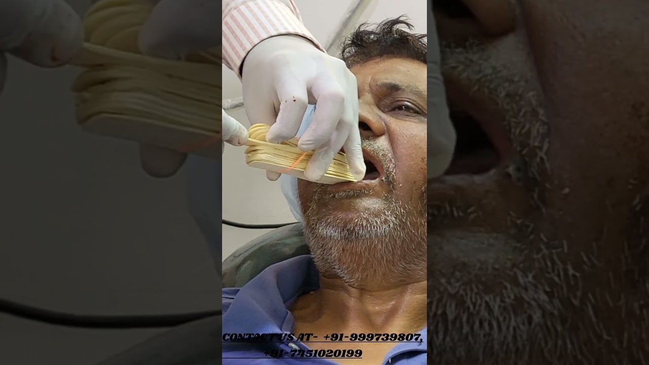 oral submucous fibrosis post surgery exercises