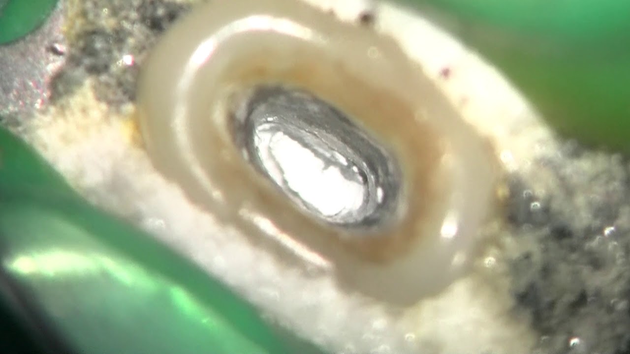 Root Canal Filling with Bioceramic Putty