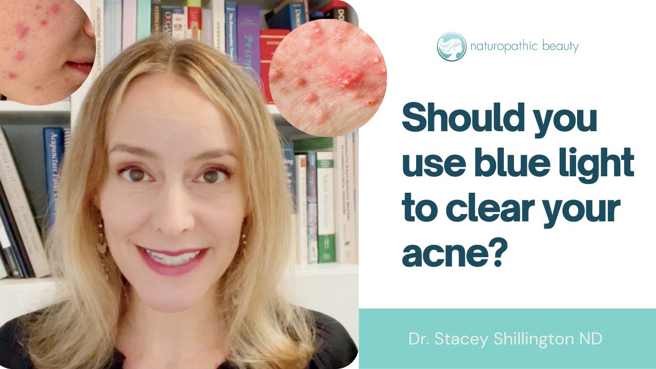 Blue LED light therapy for acne
