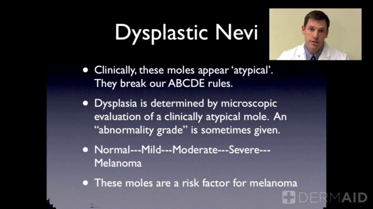 Atypical Nevi