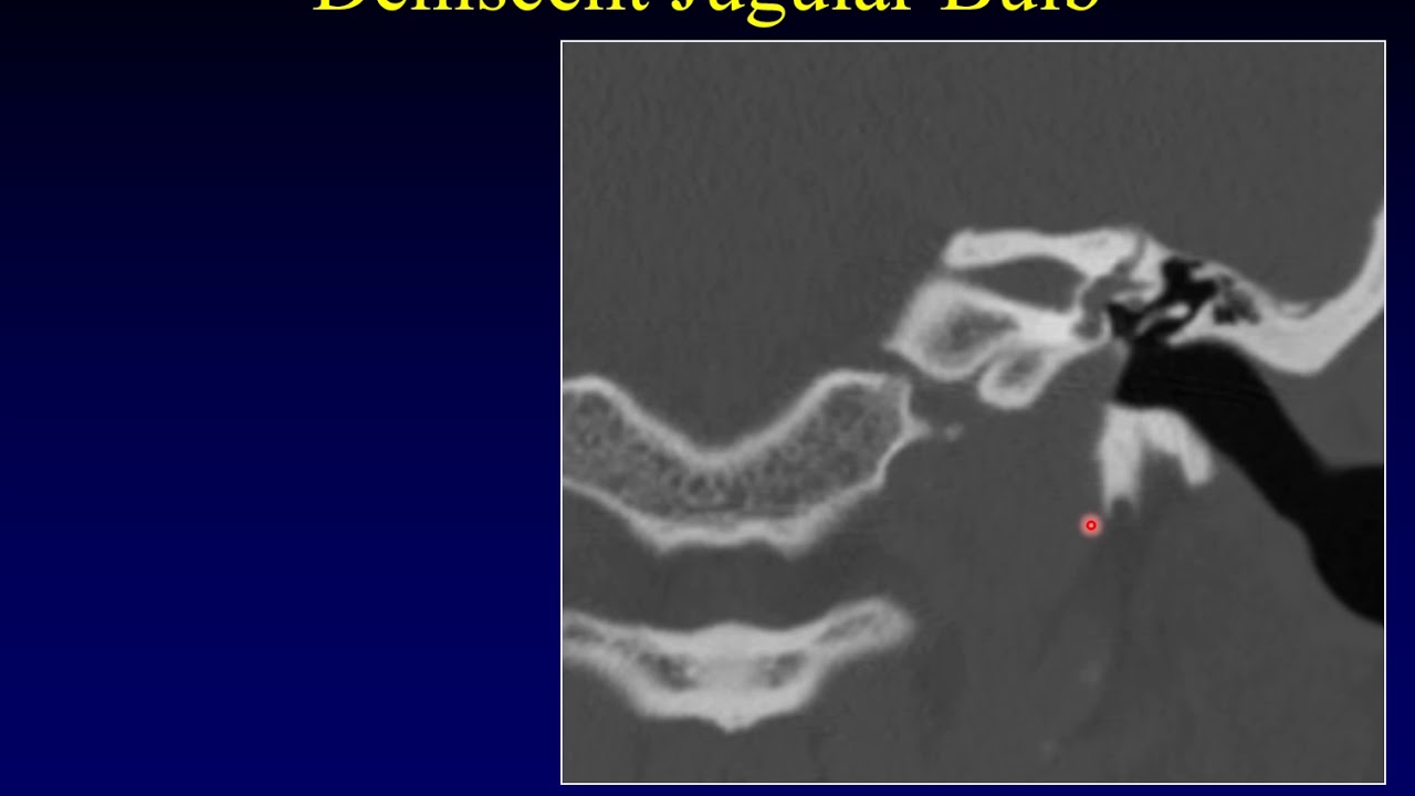 Патология височной кости 8: шум в ушах