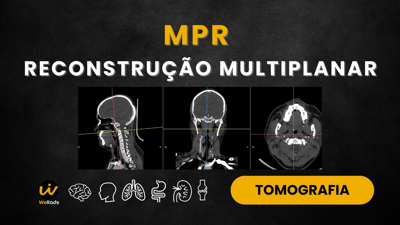 MPR - RECONSTRU&Ccedil;&Atilde;O MULTIPLANAR NA TOMOGRAFIA - O QUE &Eacute; E COMO FAZER
