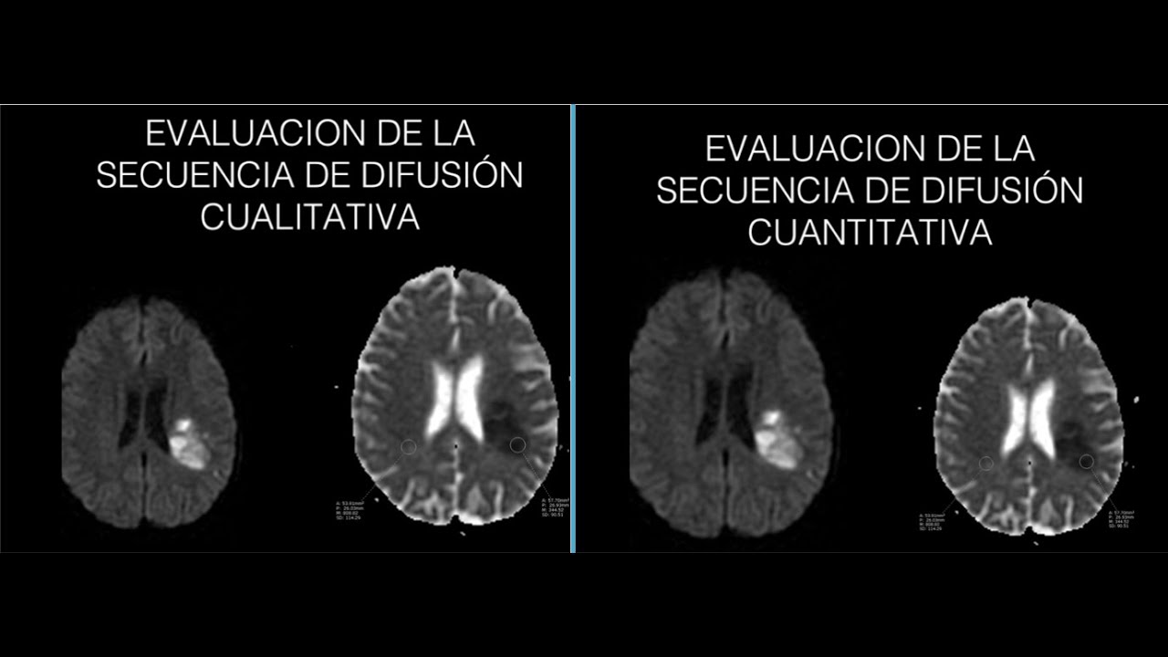 Secuencia de Difusión DWI cerebral //Parte 1//Principios básicos//Dr. Daniel Flores.