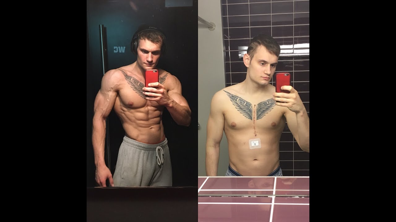 My journey through open heart surgery - Scars and tears