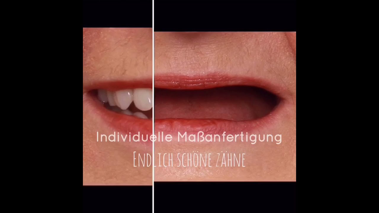 Teleskopprothese - Zahnarztpraxis Malte Schaefer