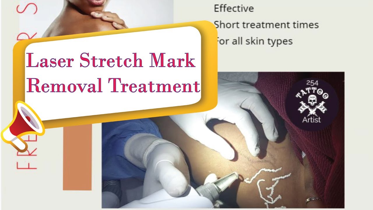 Laser Stretch Mark Removal Treatment in Nairobi Kenya