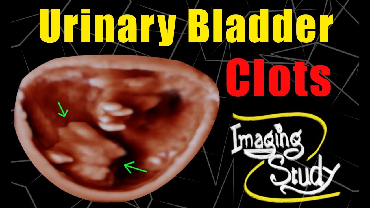 Urinary Bladder Clots || Ultrasound || Case 122