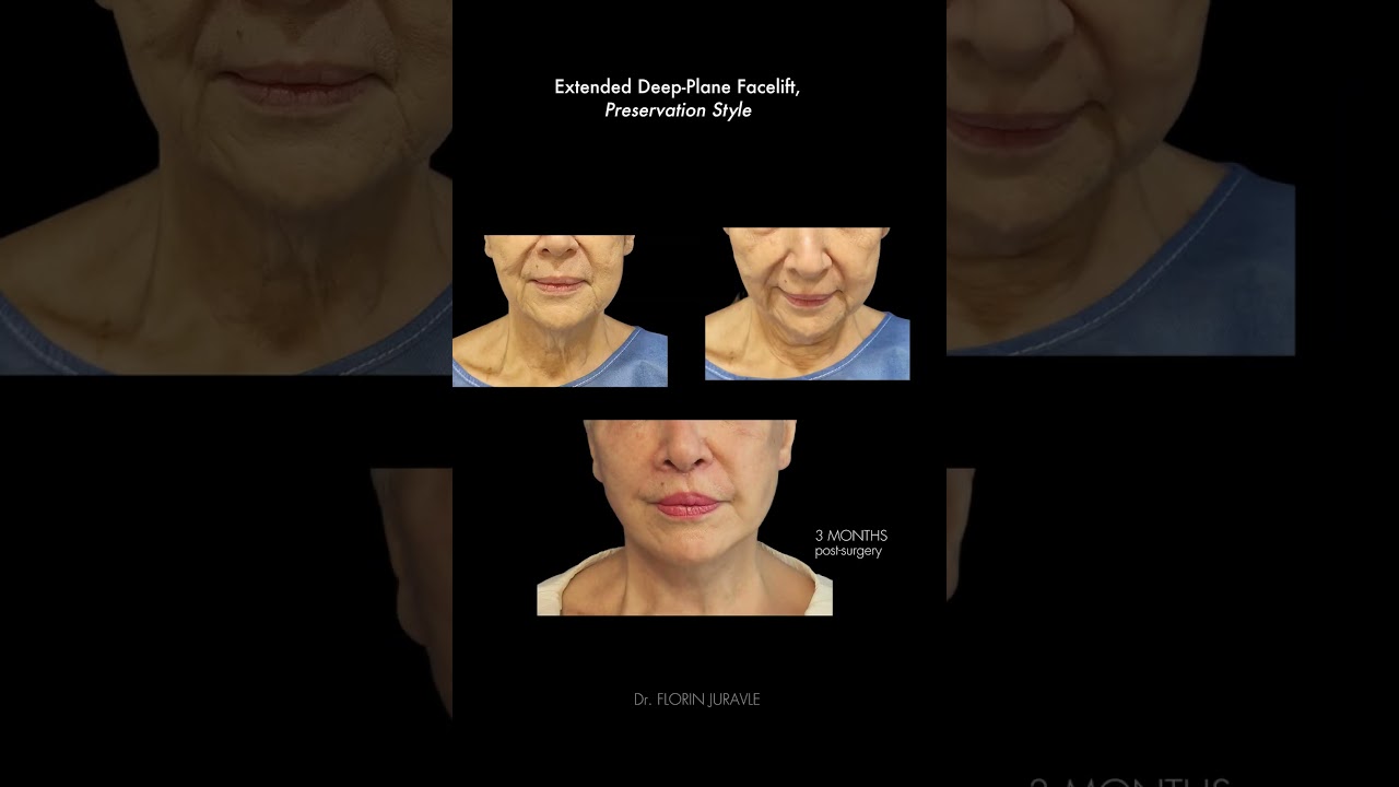 Before & After- Extended  Deep Plane Facelift, Prreservation Style, Dr. Florin Juravle