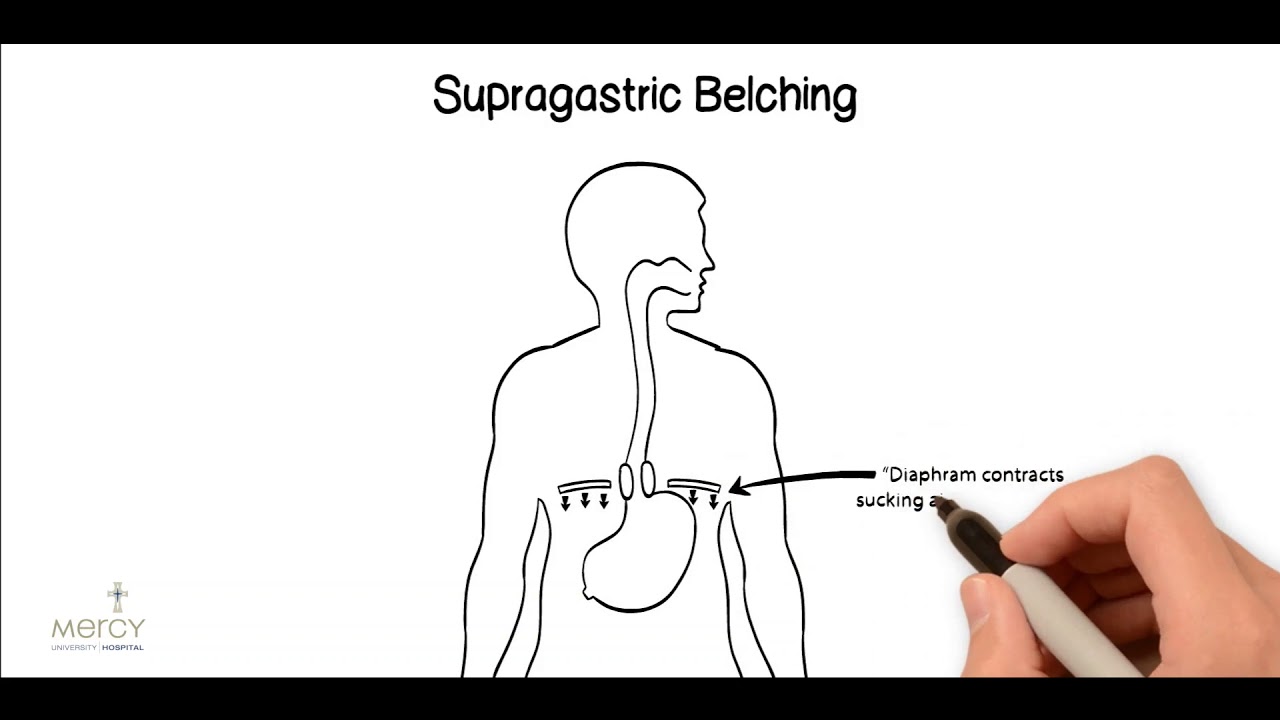 Supragastric Belching