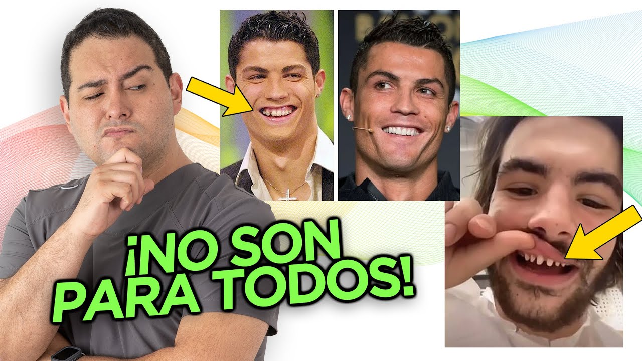&iquest;CARILLAS DENTALES O DISE&Ntilde;O DE SONRISA EN 2023? &iquest;CAMBIE DE OPINI&Oacute;N?
