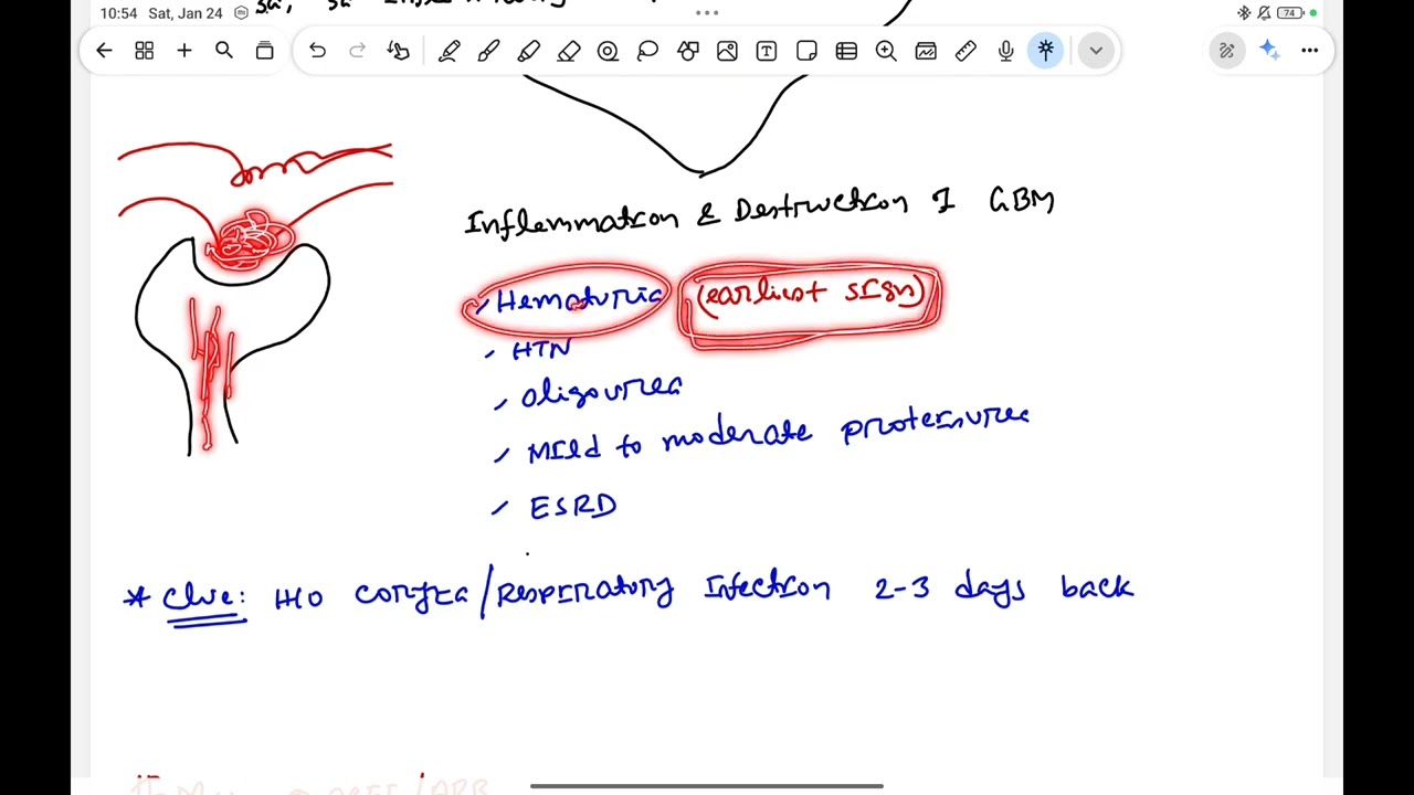 Ig-A Nephropathy 