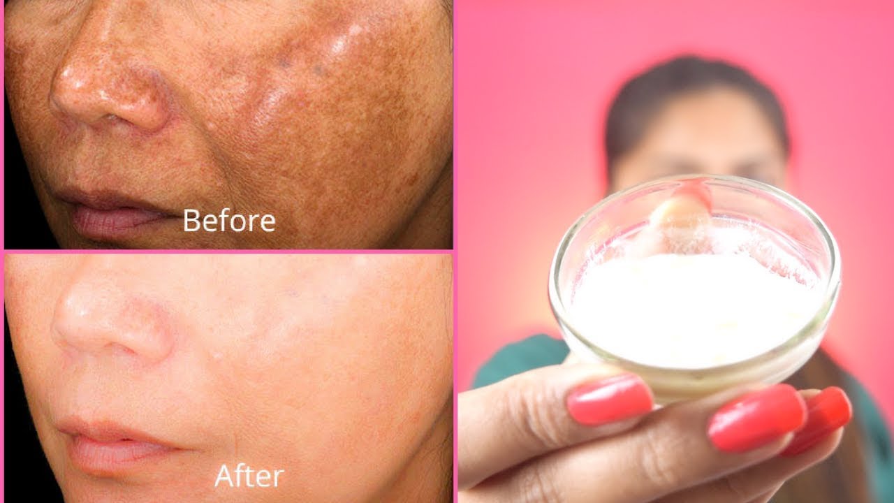 How To Get Rid of Hyper pigmentation - Freckles, Dark Spots, Melasma, Black Patches Fast Naturally