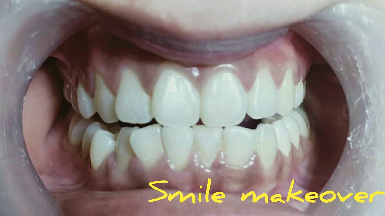 Smile Makeover Indonesia