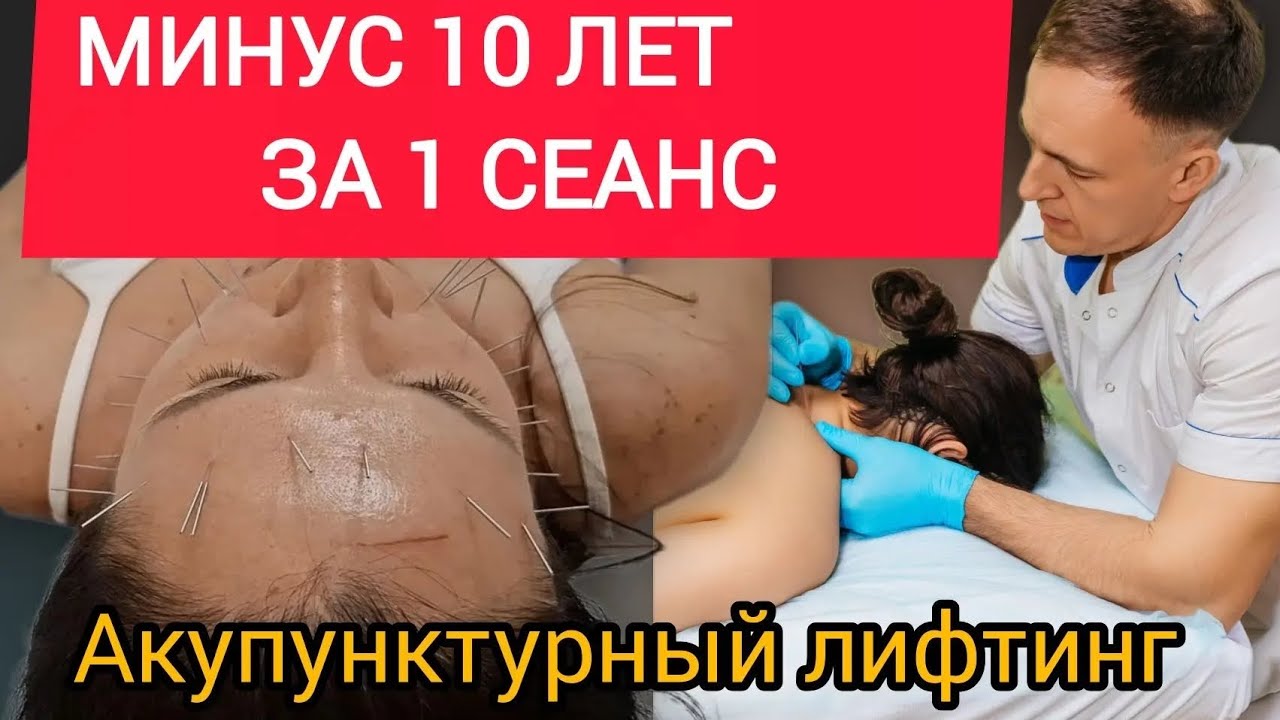 Аккупуктурный лифтинг лица.#омоложение 