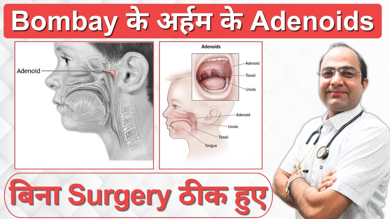Adenoids Treatment Without Surgery | Symptoms of Adenoids | Adenoids Homeopathy Treatment in Jodhpur