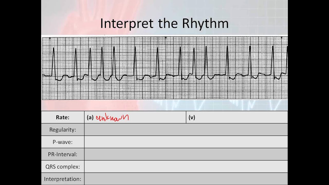 Basic Rhythm Interpretation, part 5 - The Systematic Approach, #4