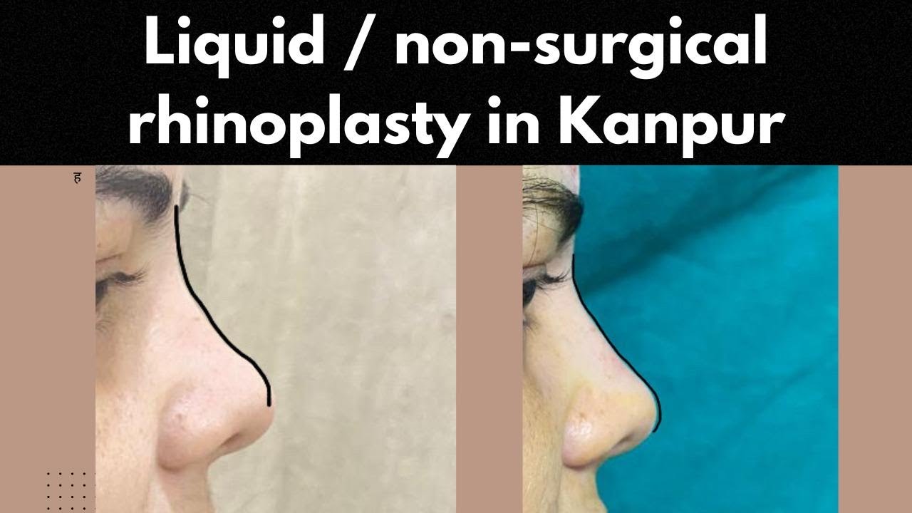 Non-surgical rhinoplasty/ Liquid rhinoplasty/ Nasal fillers@DrSKGulati