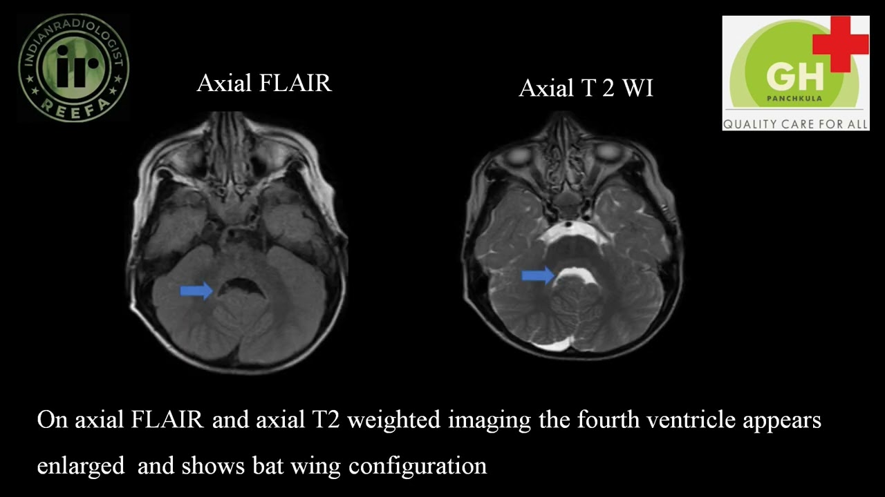 Neetu Yadav | Joubert Syndrome