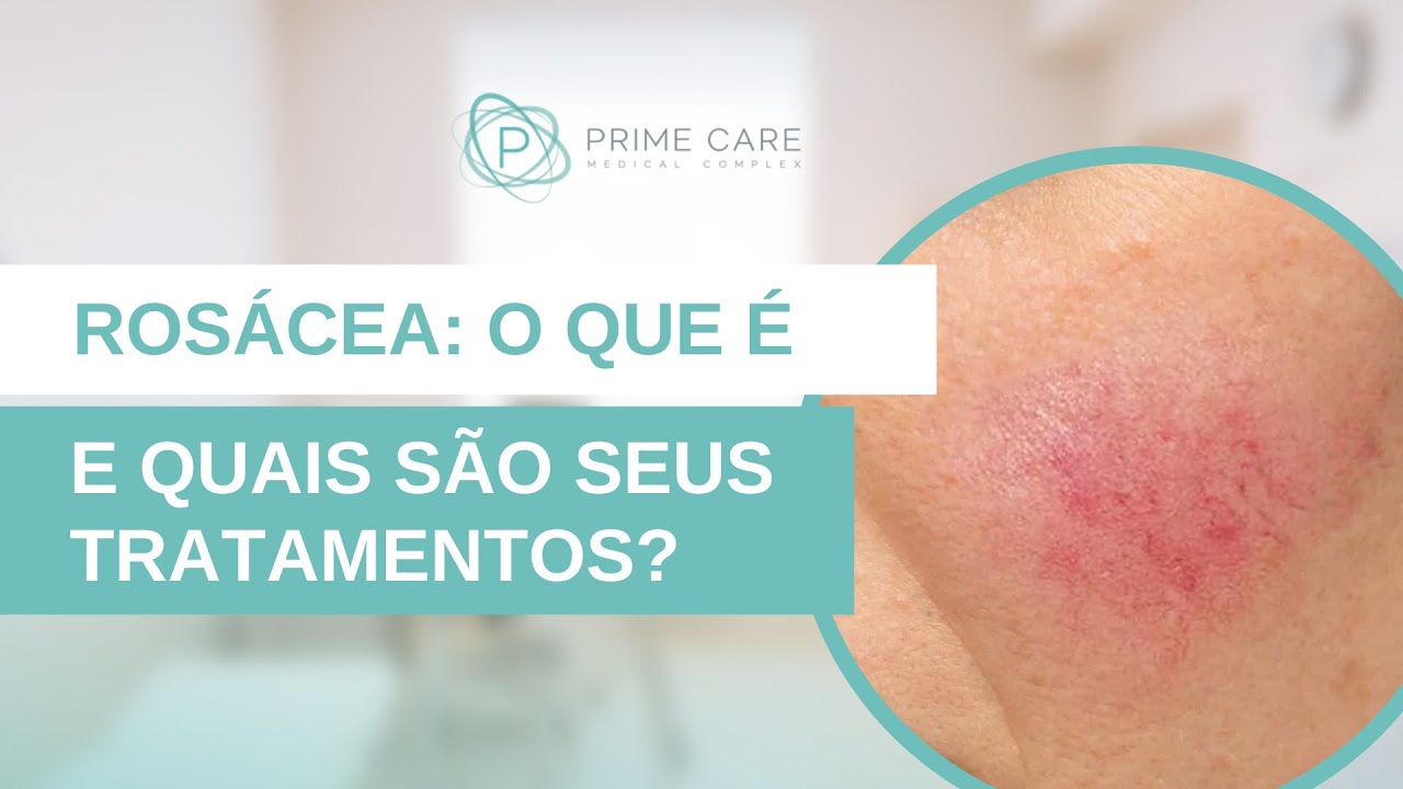 Vermelhidão no rosto? Confira o que é Rosácea e como tratar com a dermatologista Dra. Paula Ferreira