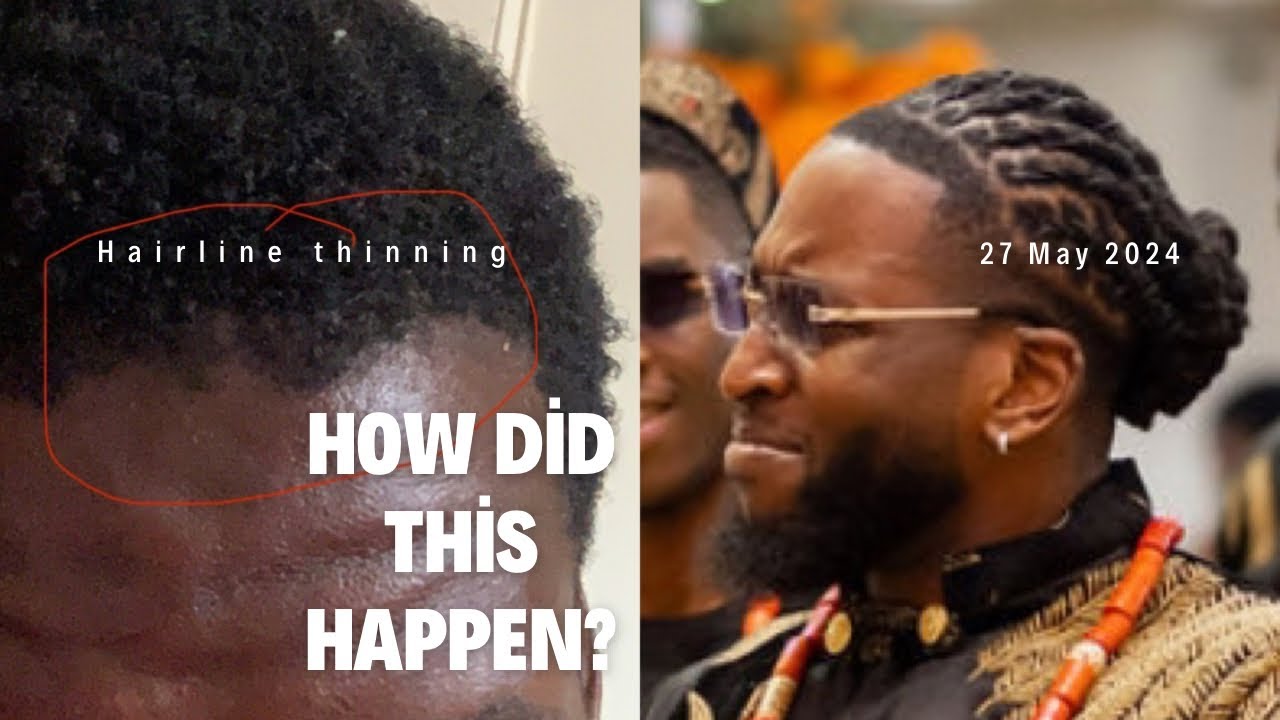 How I Fixed My Hairline (Repeatable Process)