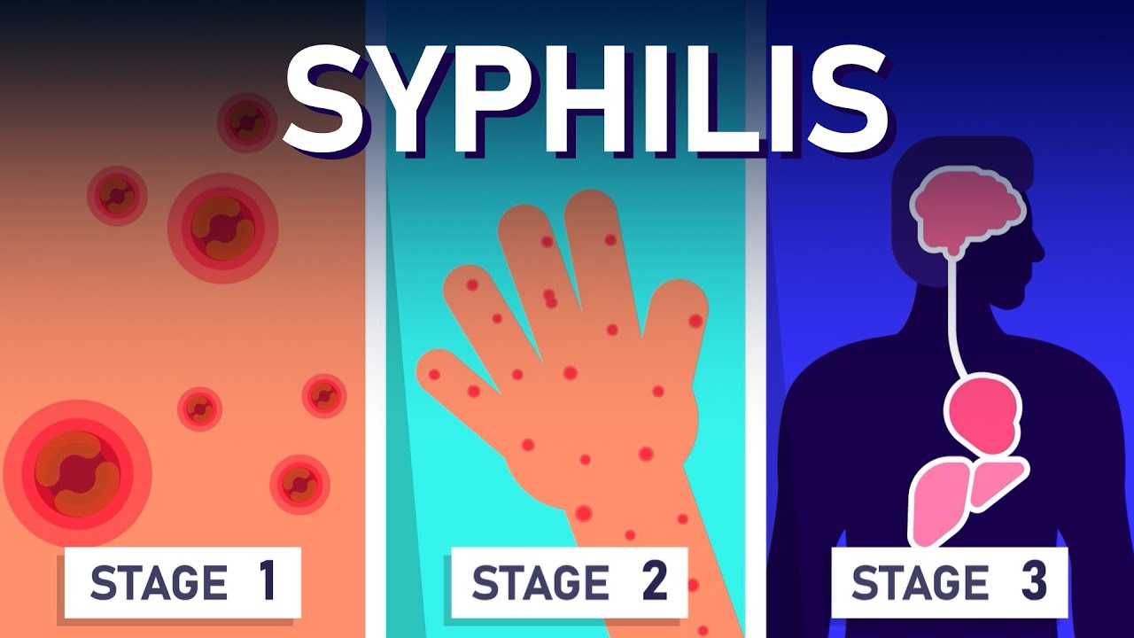 STD: Symptoms, Transmission, and Prevention