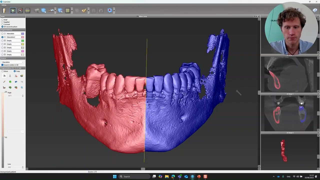 CBCT in implantology: the myth of dose reduction with small FOV