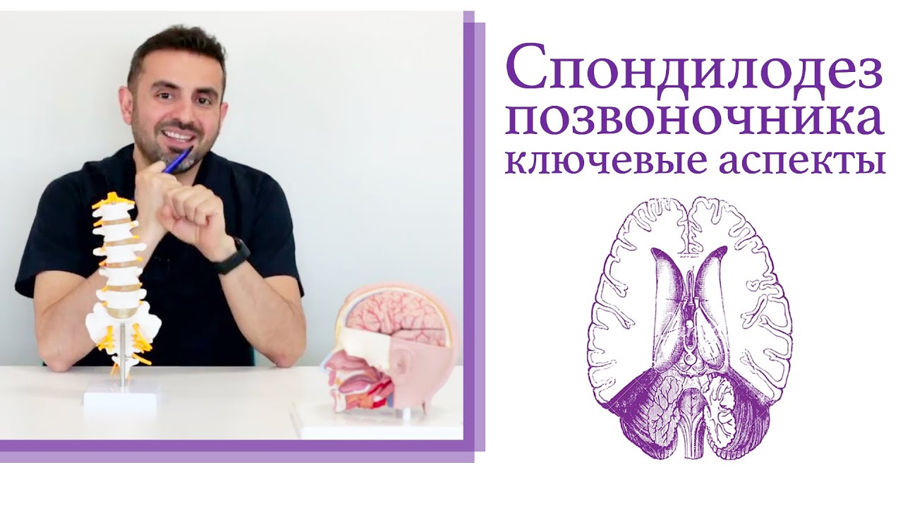 Спондилодез: ключевые аспекты метода сращивания позвонков