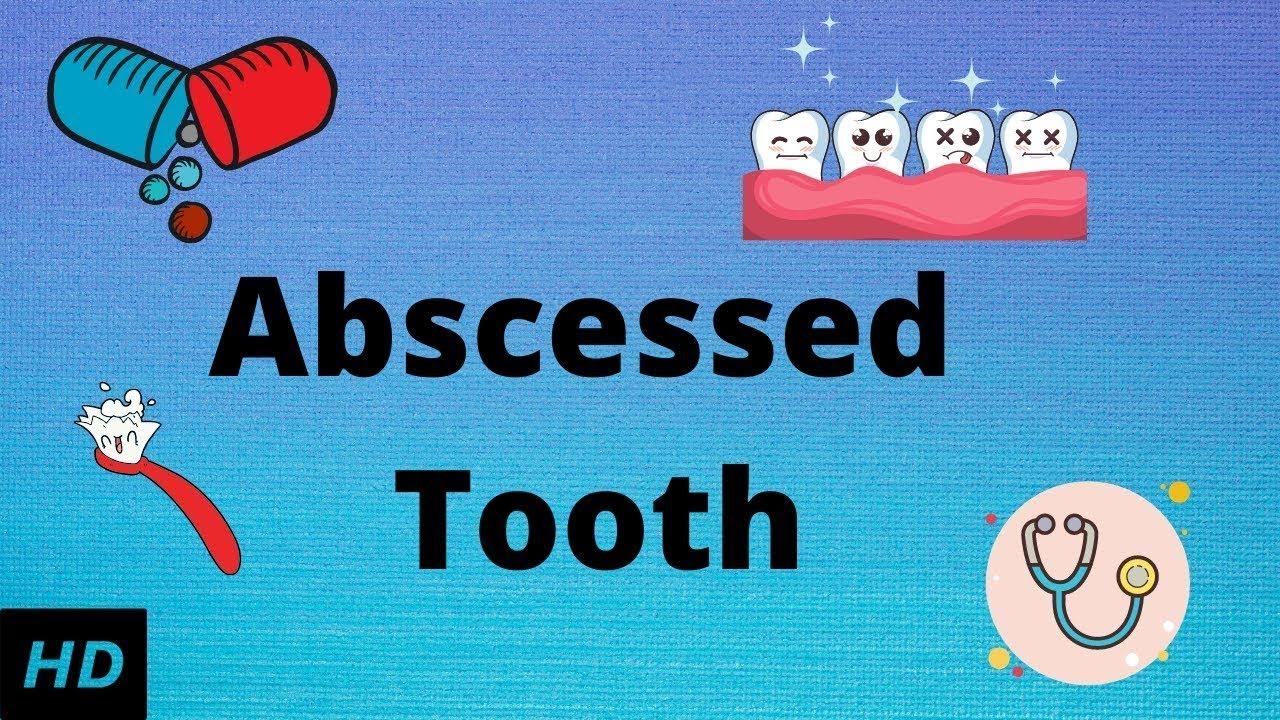 Abscessed tooth, Causes, SIgns and Symptoms, Diagnosis and Treatment