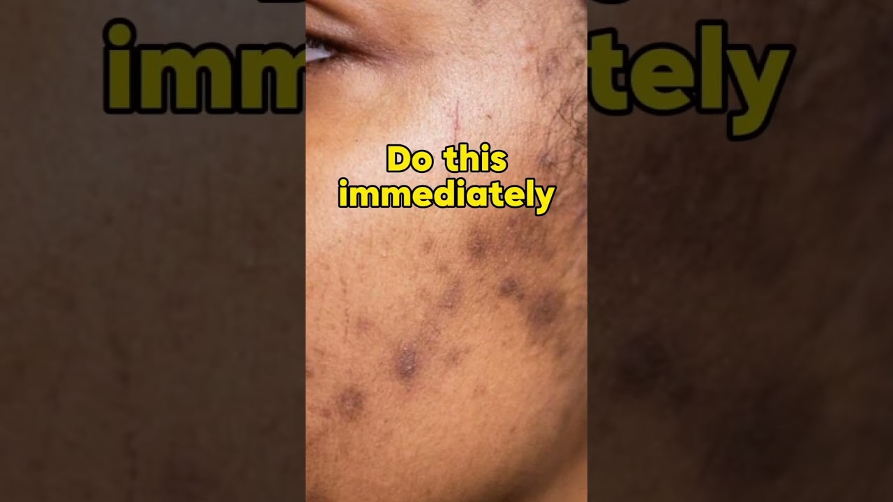 2 steps to reduce acne scars