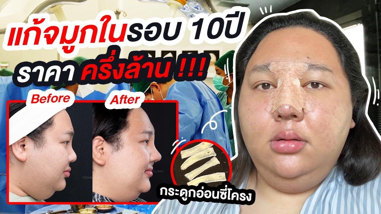 จ่ายครึ่งล้าน!! แก้จมูกในรอบ 10ปี ผ่าตัดนาน 9ชั่วโมง | จือปาก x เมโกะคลีนิค