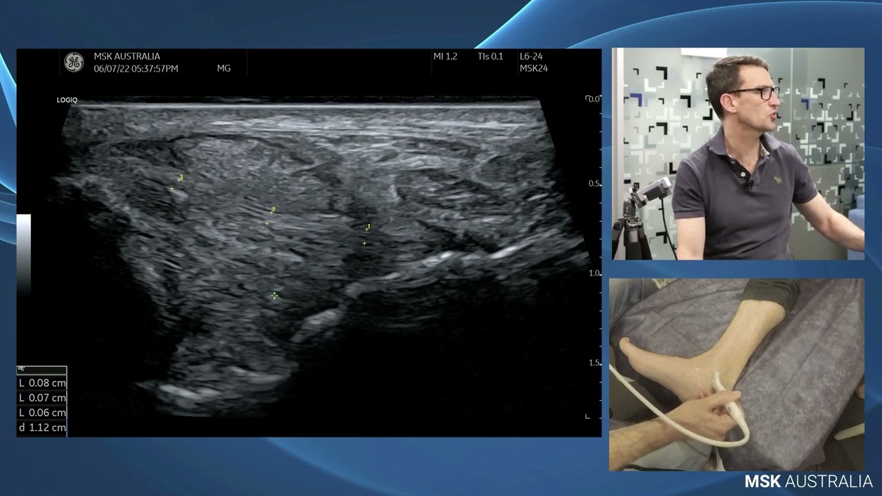Deltoid ligament of the Ankle - Scanning Technique