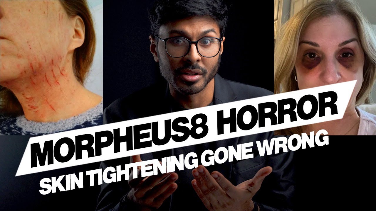 Morpheus8 Treatment Bad Results: Skin Tightening Warning