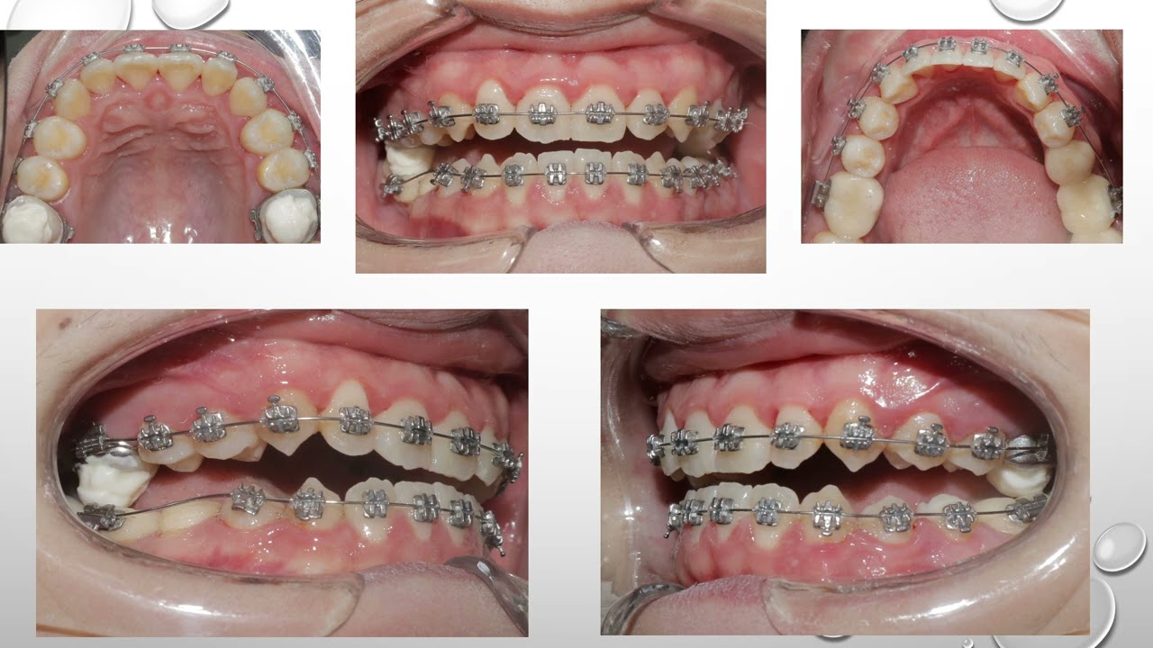 Tip Lâm sàng điều trị case hạng 3 cắn ngược với Bite turbos - Hiểu đúng về nâng khớp trong chỉnh nha