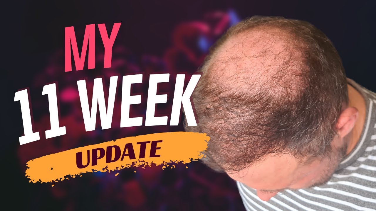 Week 11 - My Hair Transplant Journey 2.0 With ElitHair Istanbul and Dr Balwi