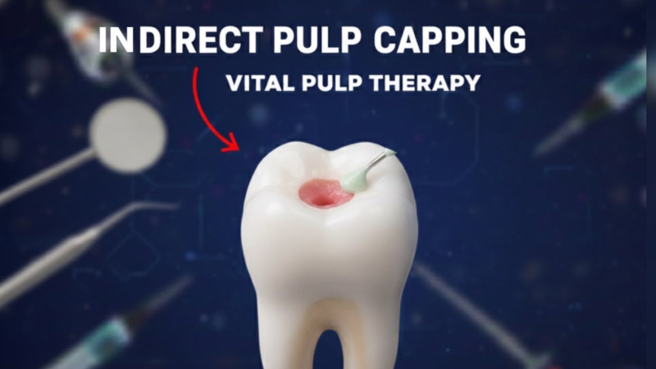 INDIRECT PULP CAPPING