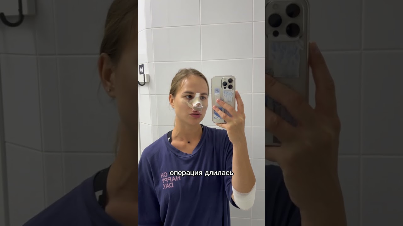 Ринопластика. 2 дня спустя