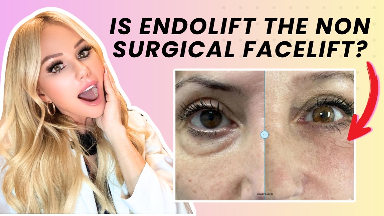 Is ENDOLIFT Worth It? Everything You Need to Know