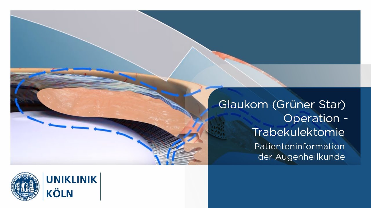Glaukom (Grüner Star) OP - Trabekulektomie (Patienteninformation Augenklinik) | Uniklinik Köln