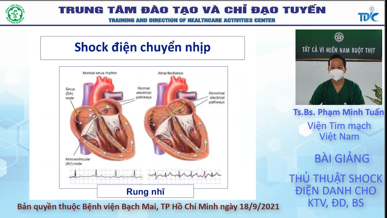 Thủ thuật shock điện dành cho KTV, ĐD và bác sĩ